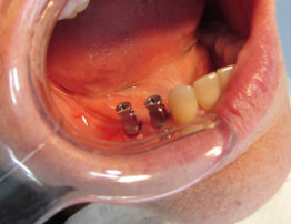 Implantología Dental